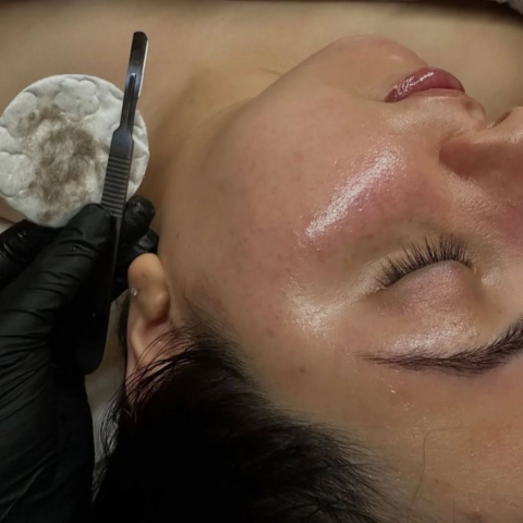 Dermaplaning Facial