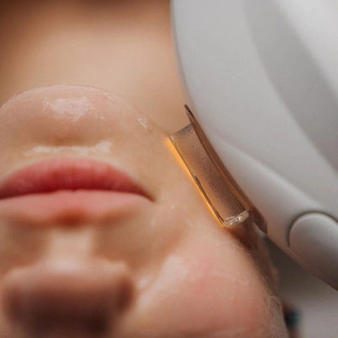 IPL Photorejuvenation Facial